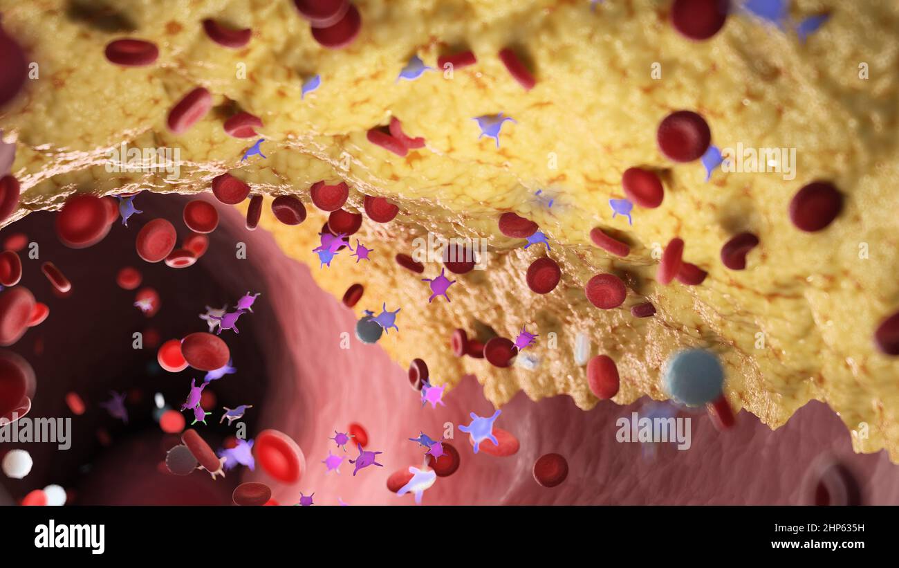 Blood flowing through an artery with a plaque, illustration. Stock Photo