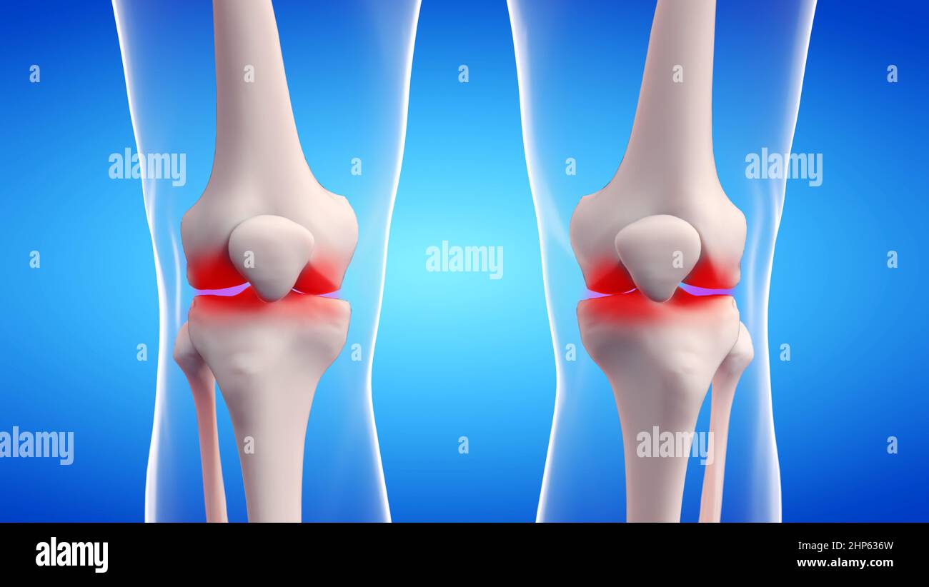 Painful knee joints, illustration. Stock Photo