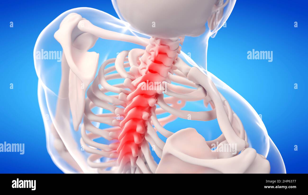Painful cervical spine, illustration. Stock Photo