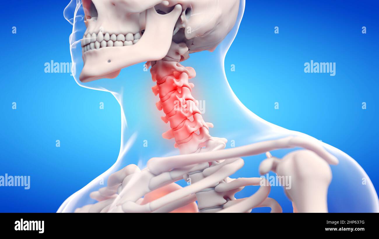 Painful cervical spine, illustration. Stock Photo