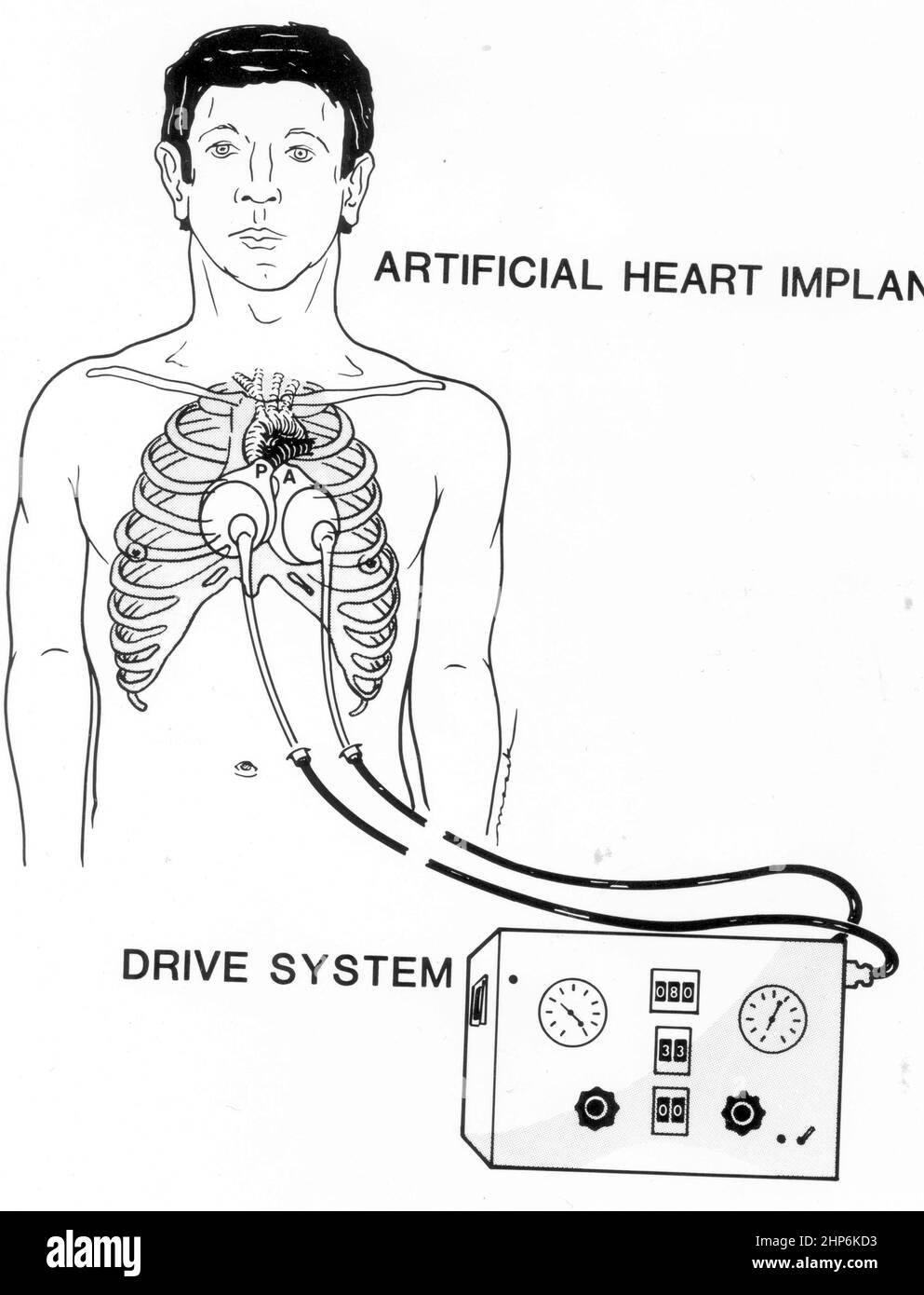 Dr. Robert Jarvik, inventor of the artificial heart Jarvik-7
