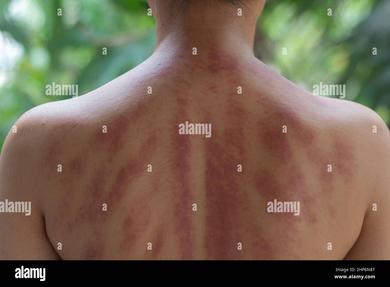 Gua Sha Chinese Is Also Called scraping spooning coining Kerokan in Indonesia Is A 