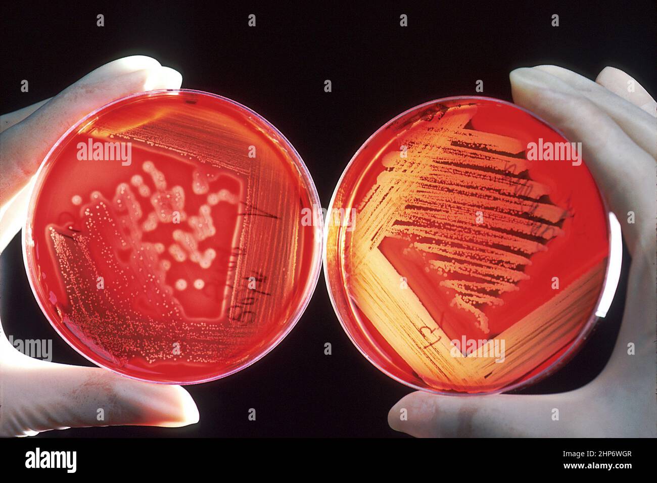 Red blood cells on an agar plate are used to diagnose infection. The plate on the left shows a positive staphyloccus infection. The plate on the right shows a positive streptococcus infection and with the halo effect shows specifically a beta-hemolytic group A. Both plates are being held by a gloved technicians hands. These infections can occur in patients on chemotherapy ca.  October 1985 Stock Photo