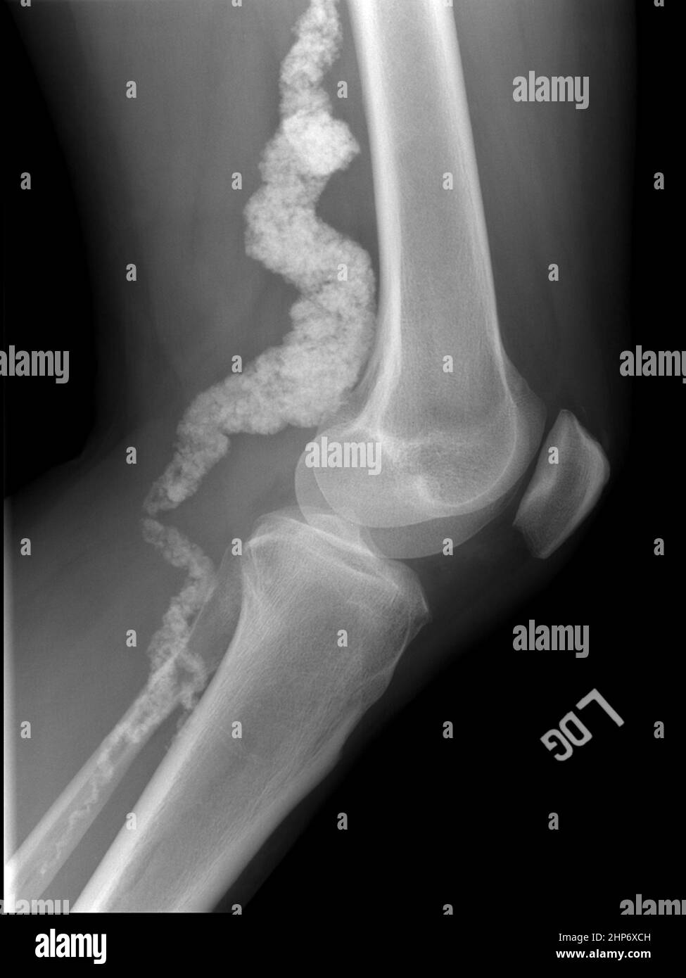 A knee x-ray of a patient with ACDC, a rare calcification disorder, reveals calcification in the main artery supplying blood to the lower leg ca.  January 21 2011 Stock Photo