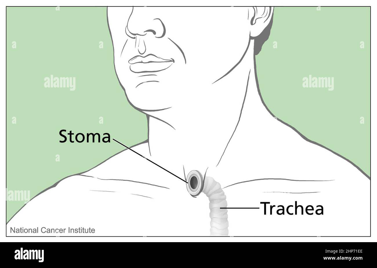 Tracheal stoma hires stock photography and images Alamy