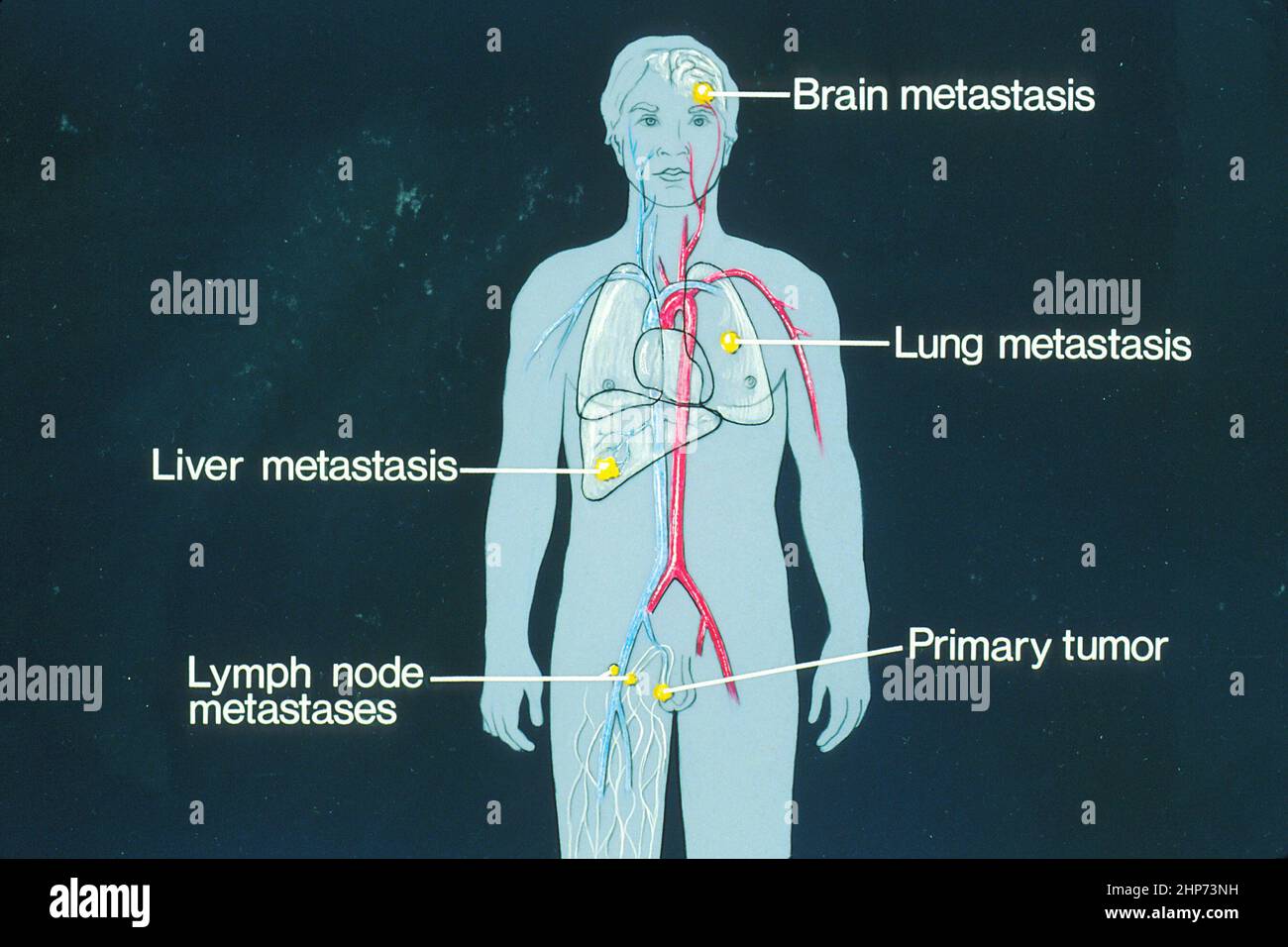This is a schematic drawing of sites of potential metastases. The primary tumor and metastases to the brain, lung, liver and lymph nodes on the human body ca.  August 1988 Stock Photo