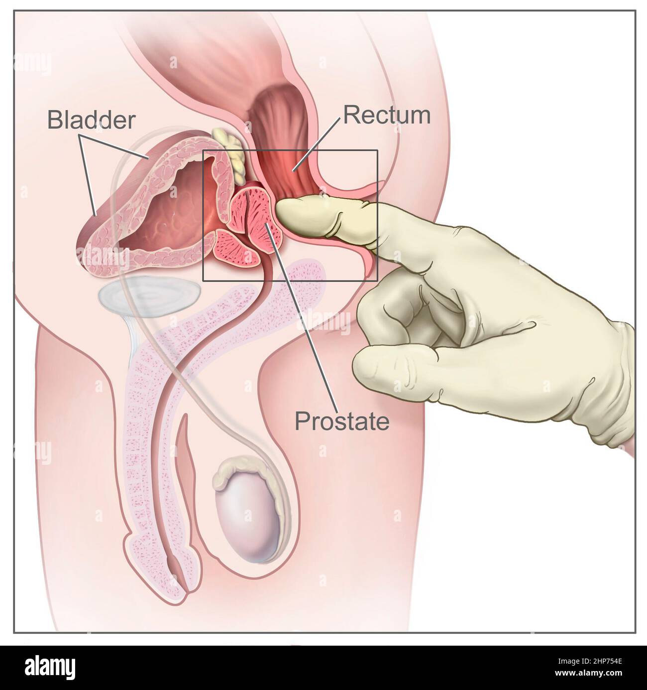 Digital rectal exam; drawing shows a side view of the male reproductive and urinary anatomy, including the prostate, rectum, and bladder; also shows a gloved and lubricated finger inserted into the rectum to feel the prostate. ca.  2008 Stock Photo