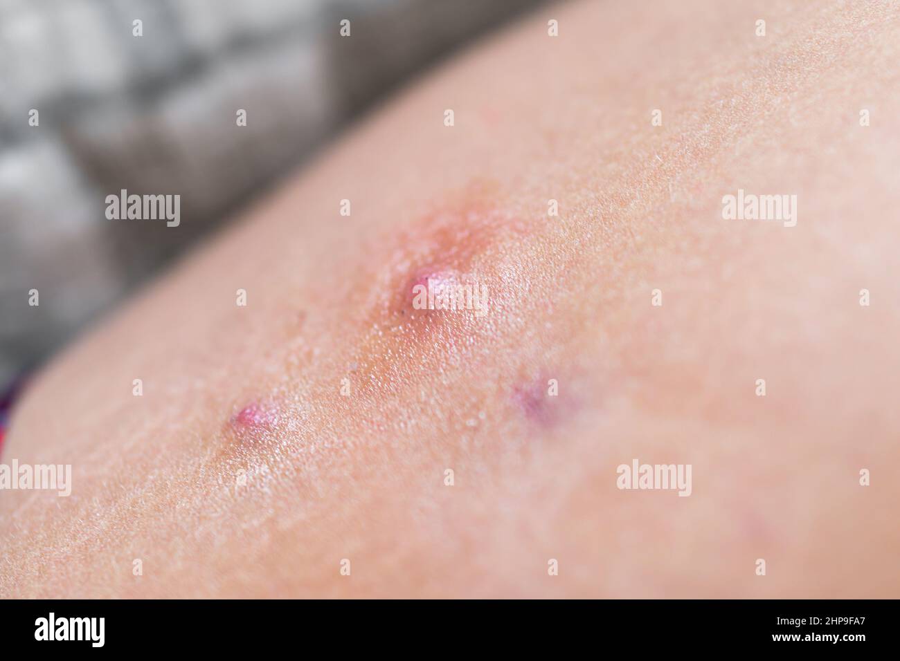 Macro closeup of red swollen boil pimple on leg skin of female woman showing medical condition called hidradenitis suppurativa Stock Photo