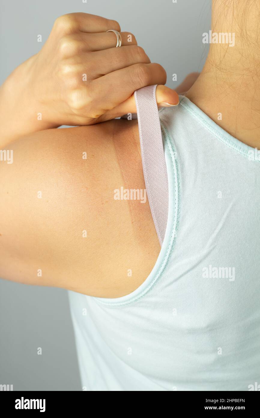 A mark on the body from an uncomfortable bra. Stock Photo
