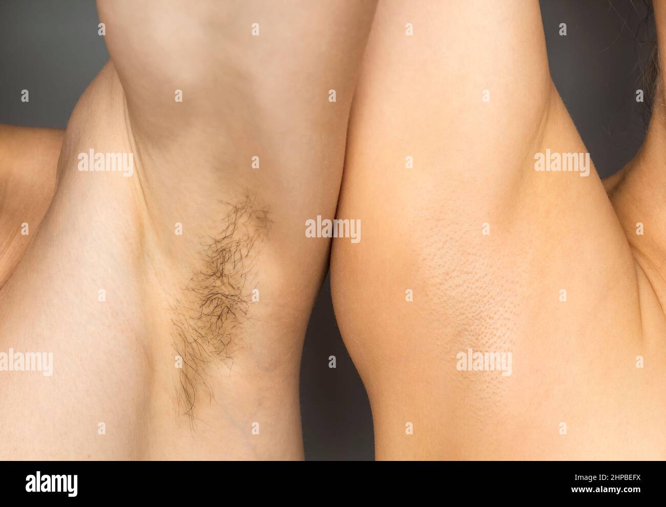 Two armpits with and without hair. Laser hair removal concept. Stock Photo