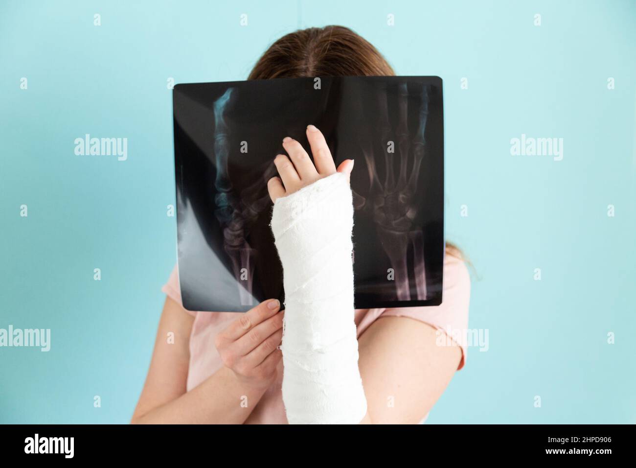 Woman with broken arm is looking at her X-ray. Stock Photo