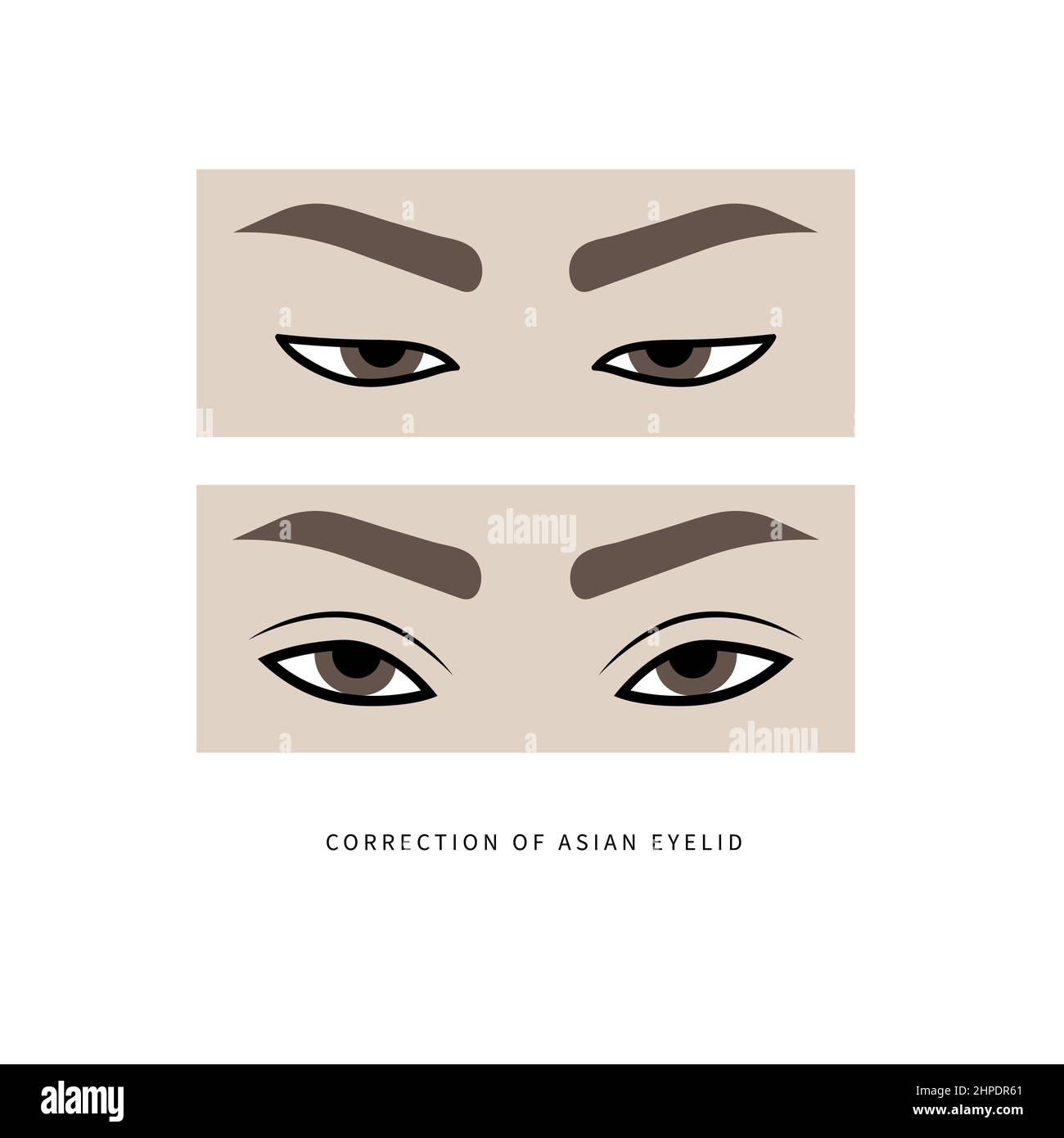 Plastic surgery for formation of upper eyelid Stock Vector