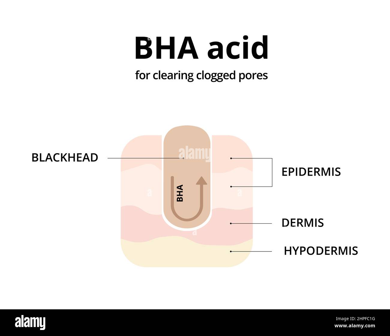 BHA acid for cleaning clogged pores. Removing blackheads, salicylic acid, oily skin. For topics like cosmetology, treatment, exfoliating Stock Vector