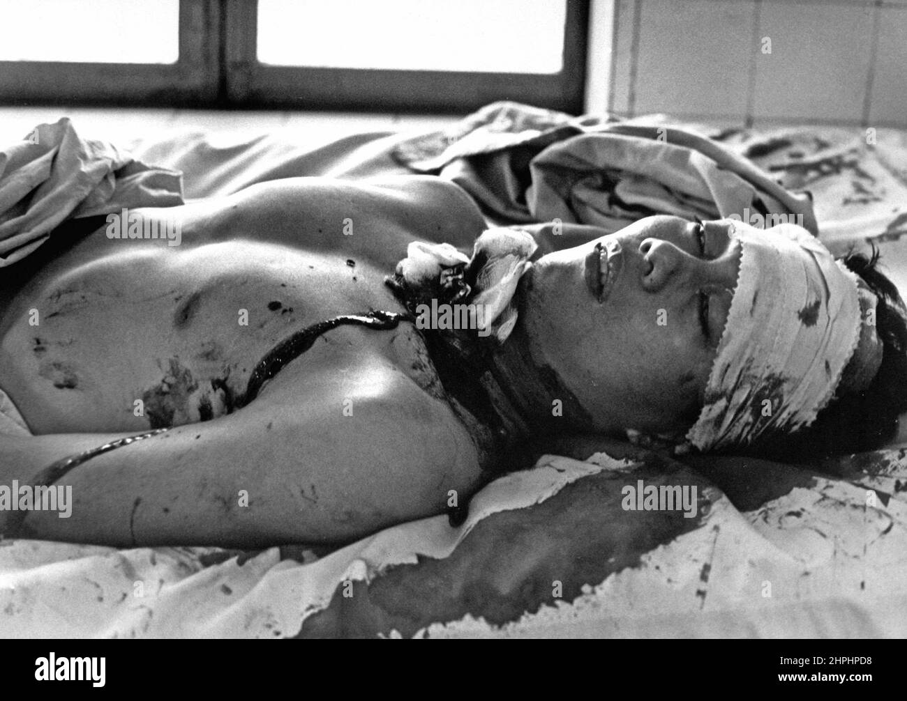 One of 48 persons wounded by a Viet Cong explosion which killed 14 in Saigon awaits treatment in the Cong Hoa Hospital. Blast was set off on a busy street corner and the victims included women and children ca.  February 1966 Stock Photo