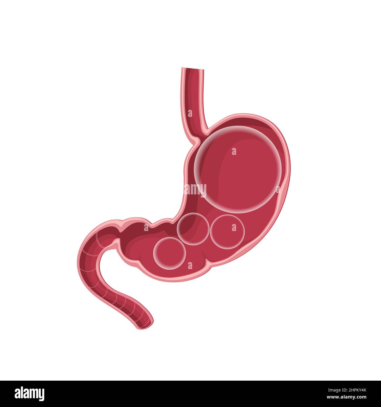 Medical illustration of Abdominal bloated stomach. Transperant ball