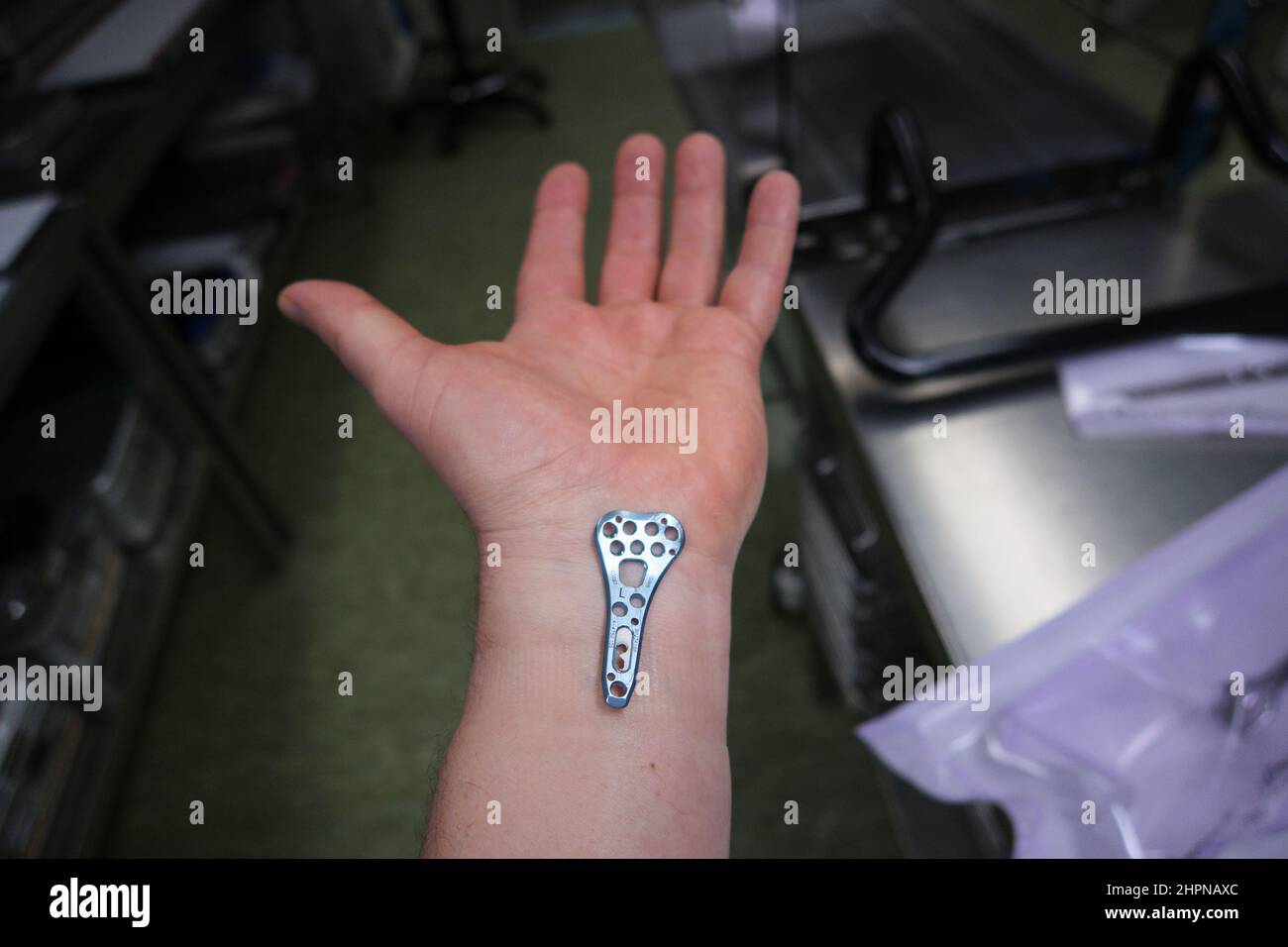 an explanted surgical blue titanium radius plate lies on the wrist