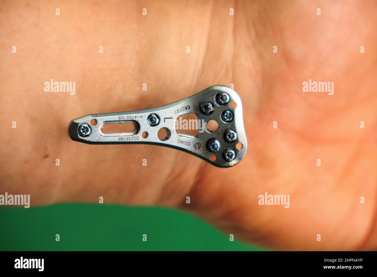 an explanted surgical blue titanium radius plate lies on the wrist Stock Photo Alamy