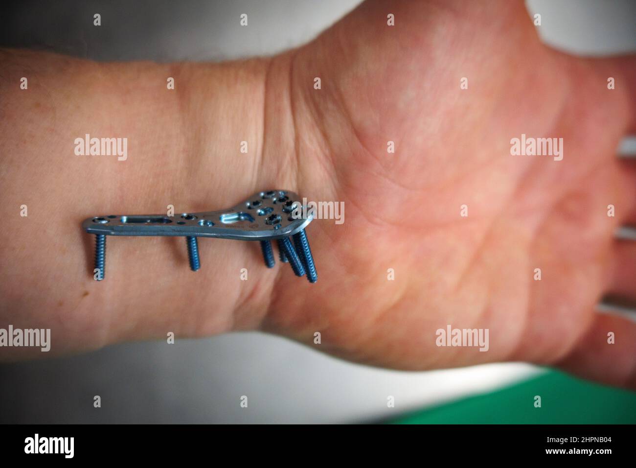 an explanted surgical blue titanium radius plate lies on the wrist