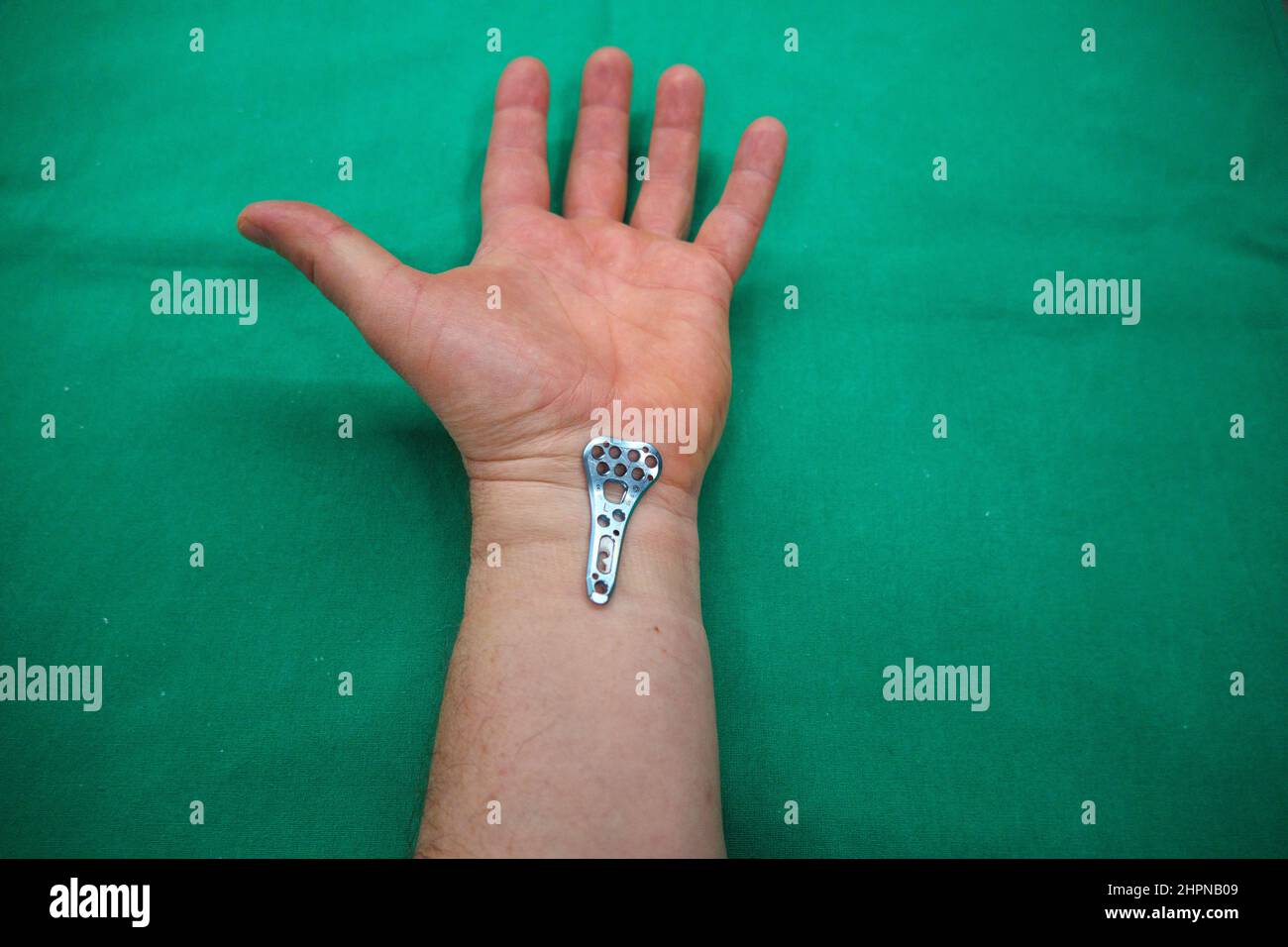 an explanted surgical blue titanium radius plate lies on the wrist