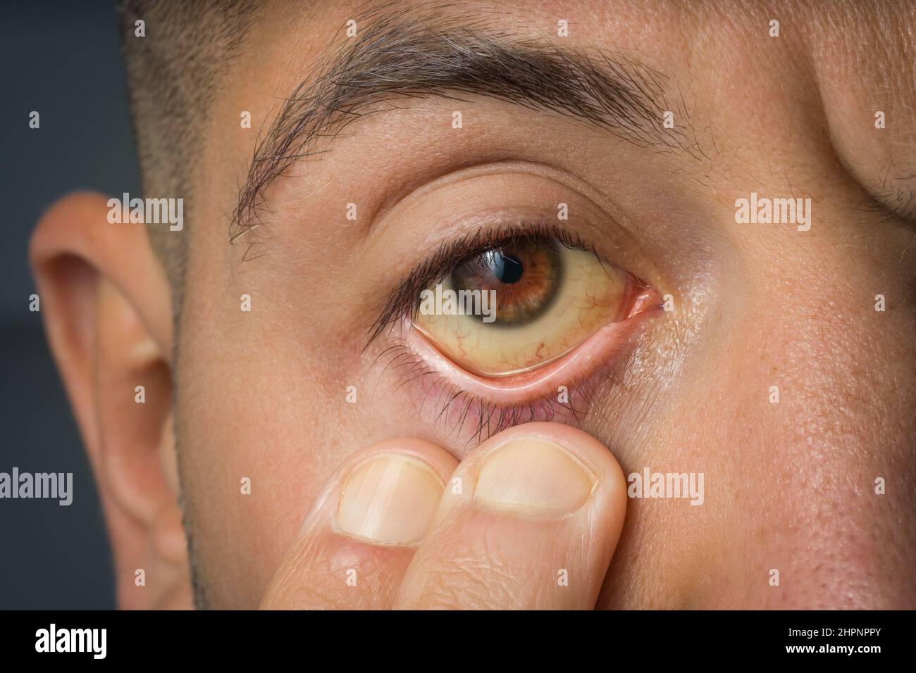 Discover more than 147 bags under eyes liver best kidsdream.edu.vn