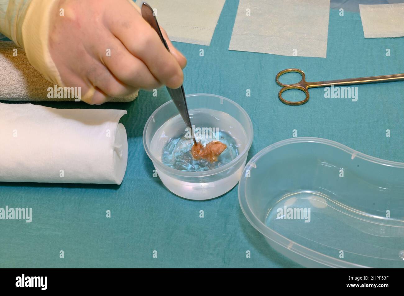 Skin graft being placed in a sterile saline solution Stock Photo Alamy