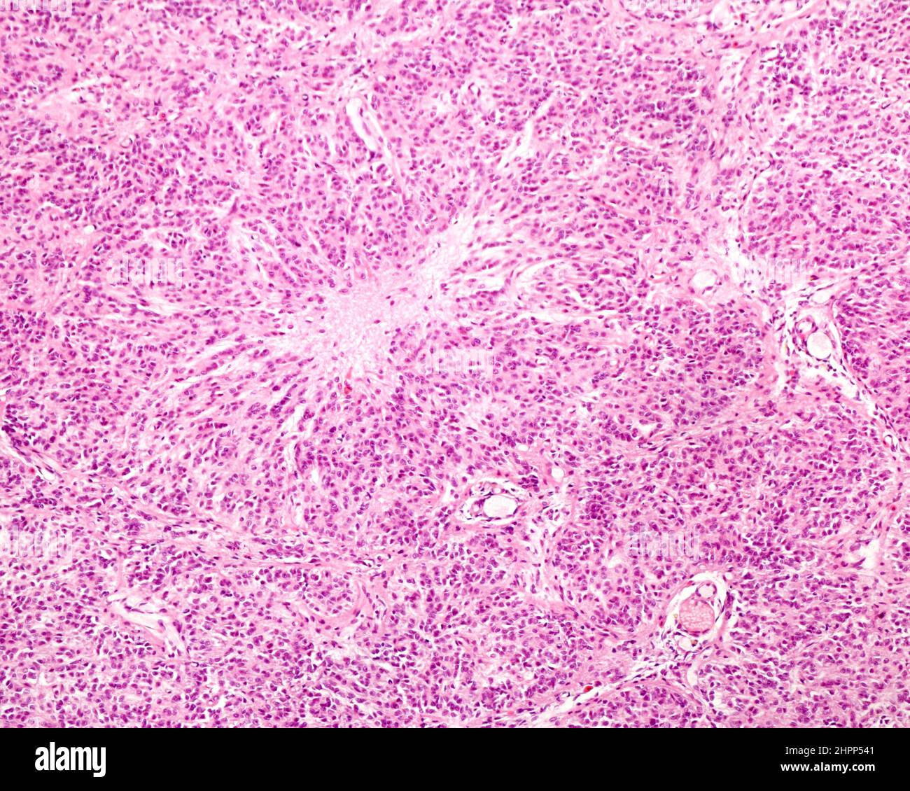 Human pineal gland glial scar, light micrograph Stock Photo - Alamy