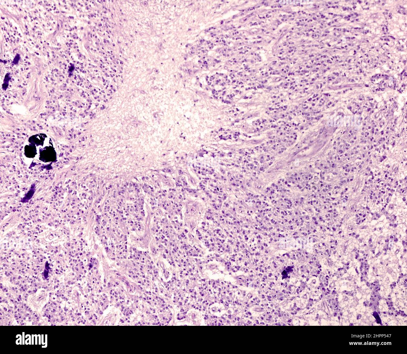 Human pineal gland glial scar, light micrograph Stock Photo - Alamy