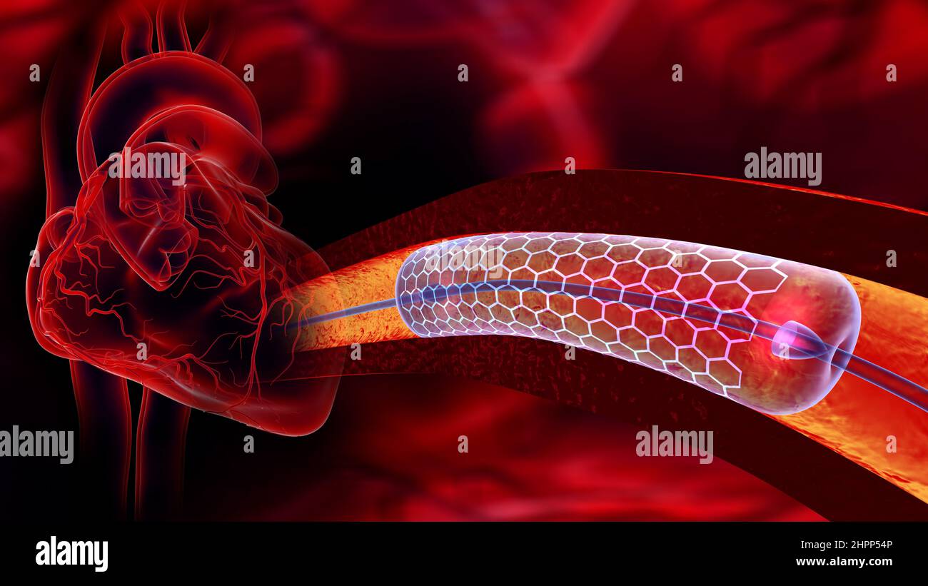 Cardiac catheter with stent, illustration Stock Photo Alamy