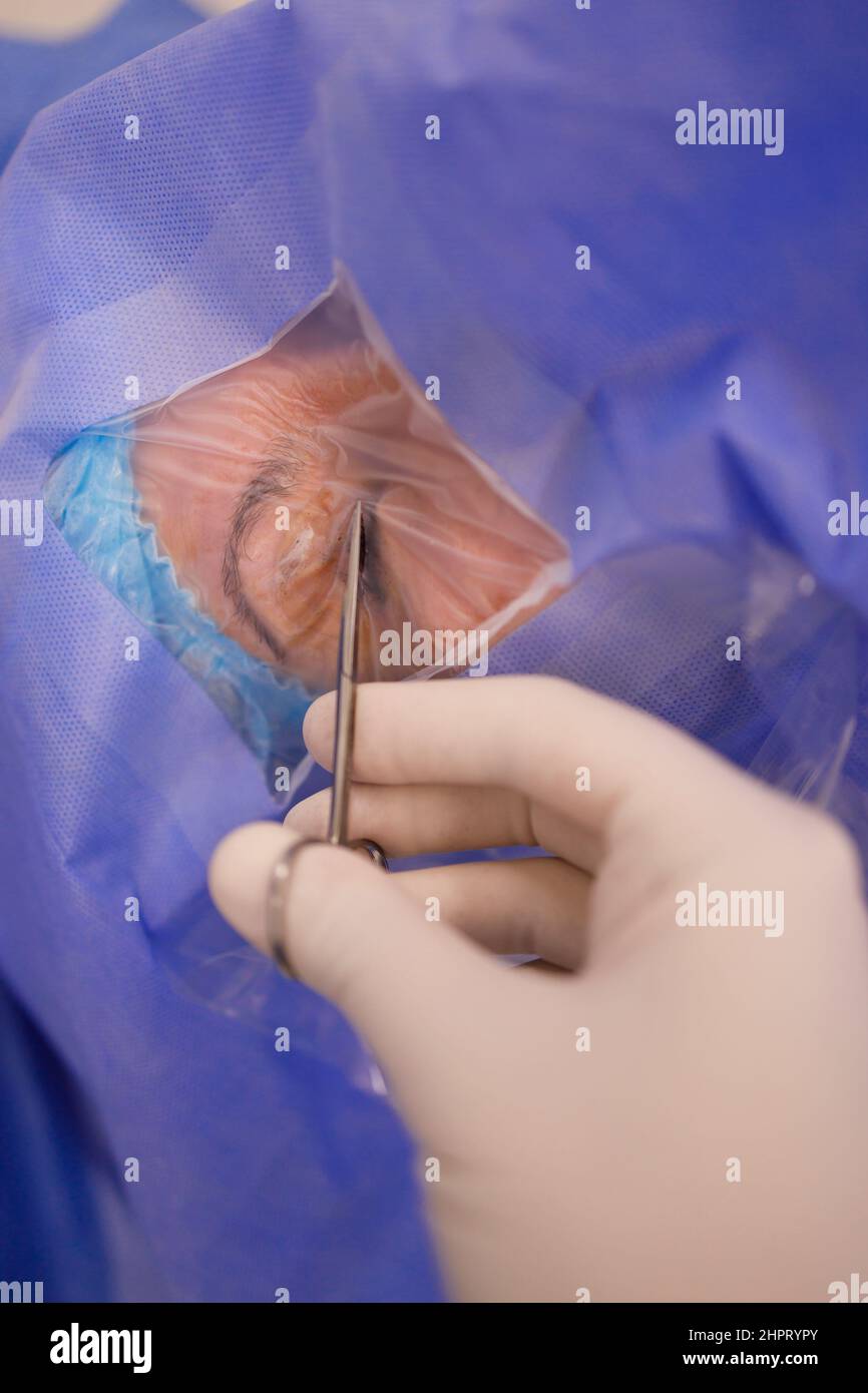Detail of a surgeon preparing the area around the eye for a surgery Stock Photo