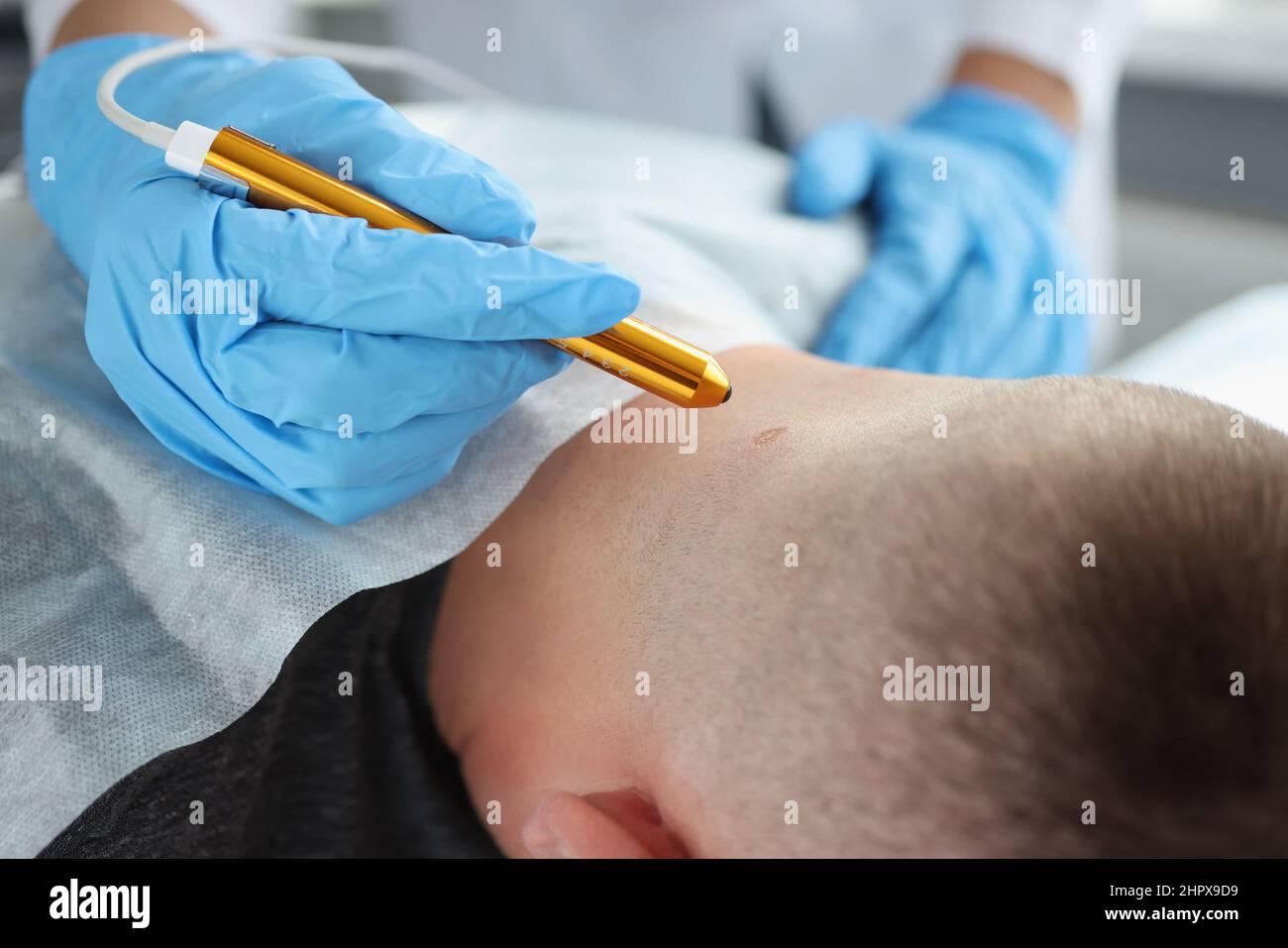 A doctor removes a wart from a man's neck, close-up Stock Photo