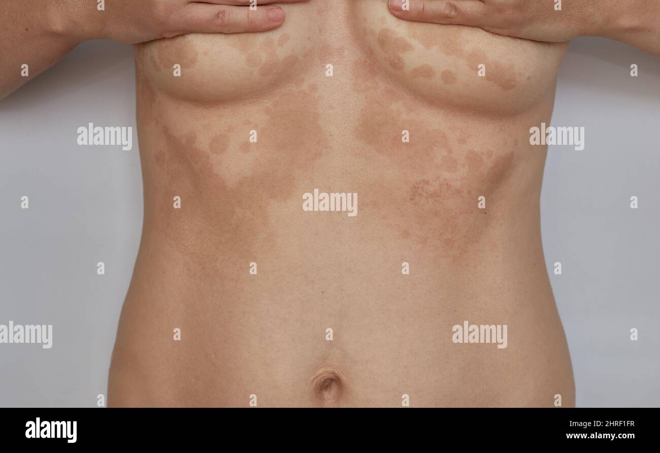 Shingles, Pityriasis on the skin. Skin diseases and dermatological problems Stock Photo