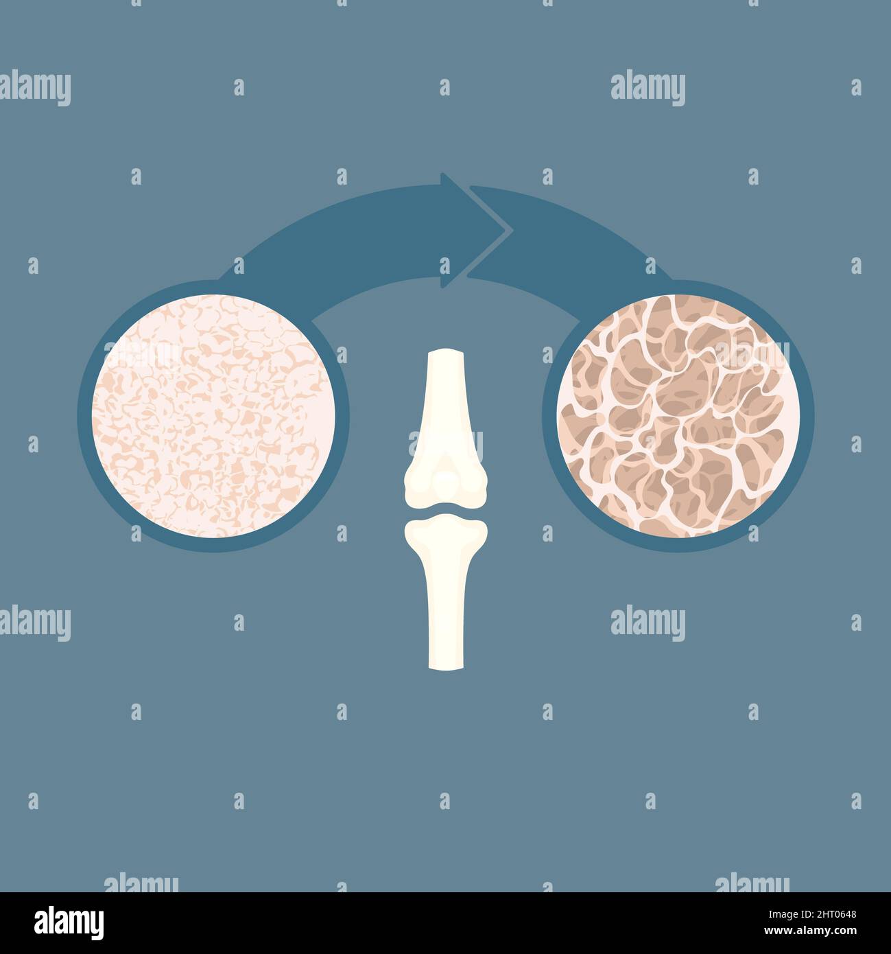 Bone loss hi-res stock photography and images - Alamy