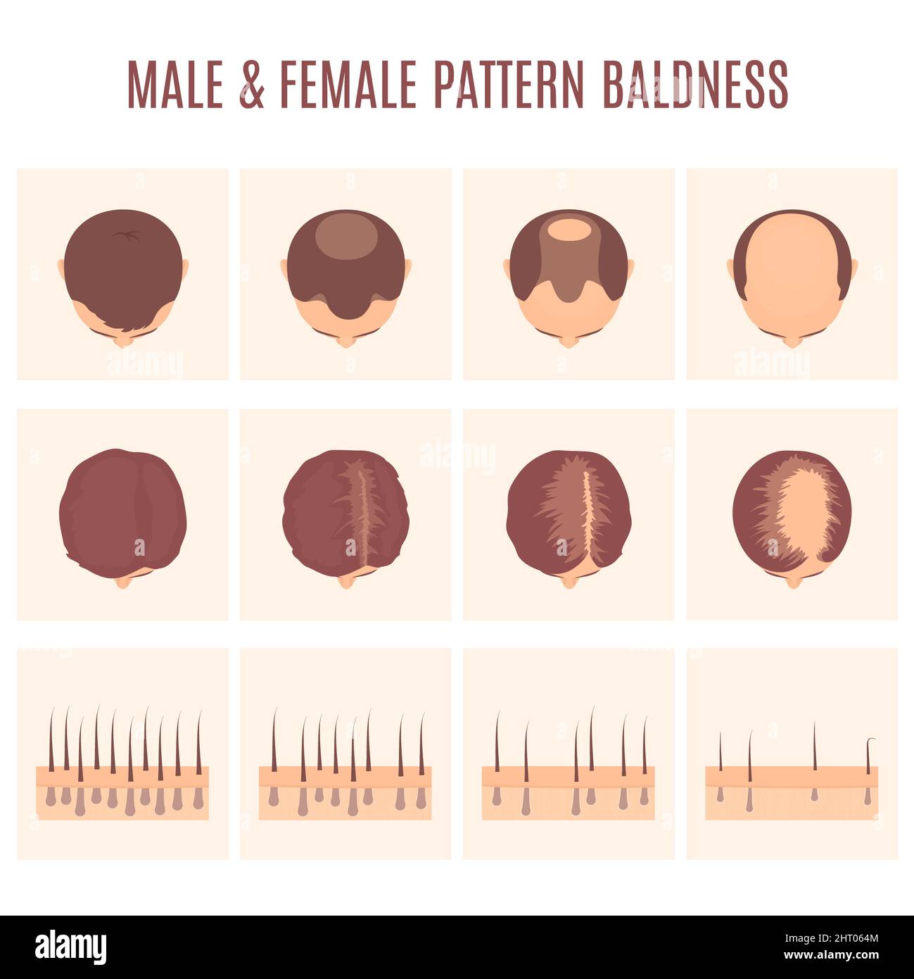Male and female hair loss patterns, conceptual illustration Stock Photo