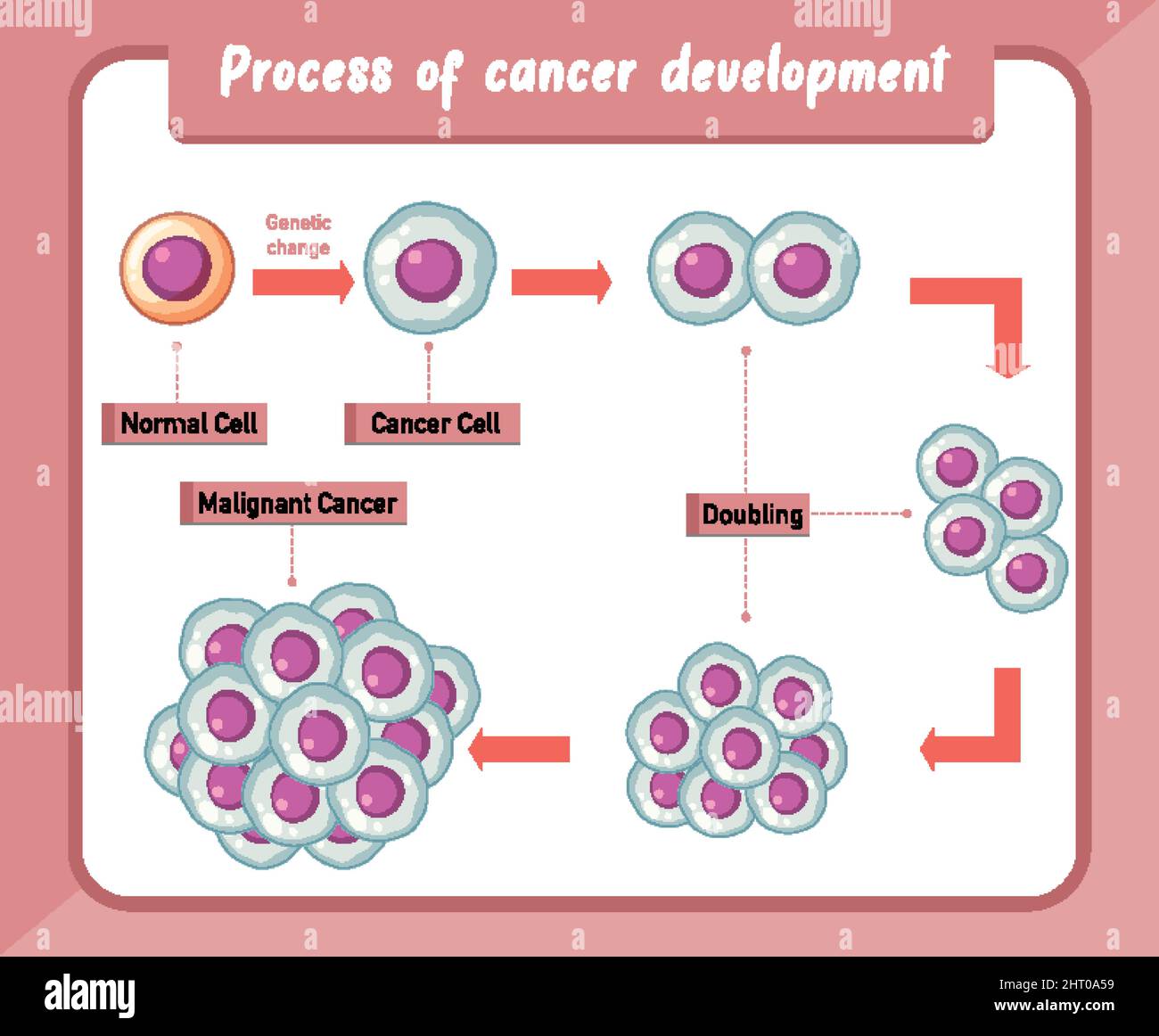 Process of cancer development infographic illustration Stock Vector ...