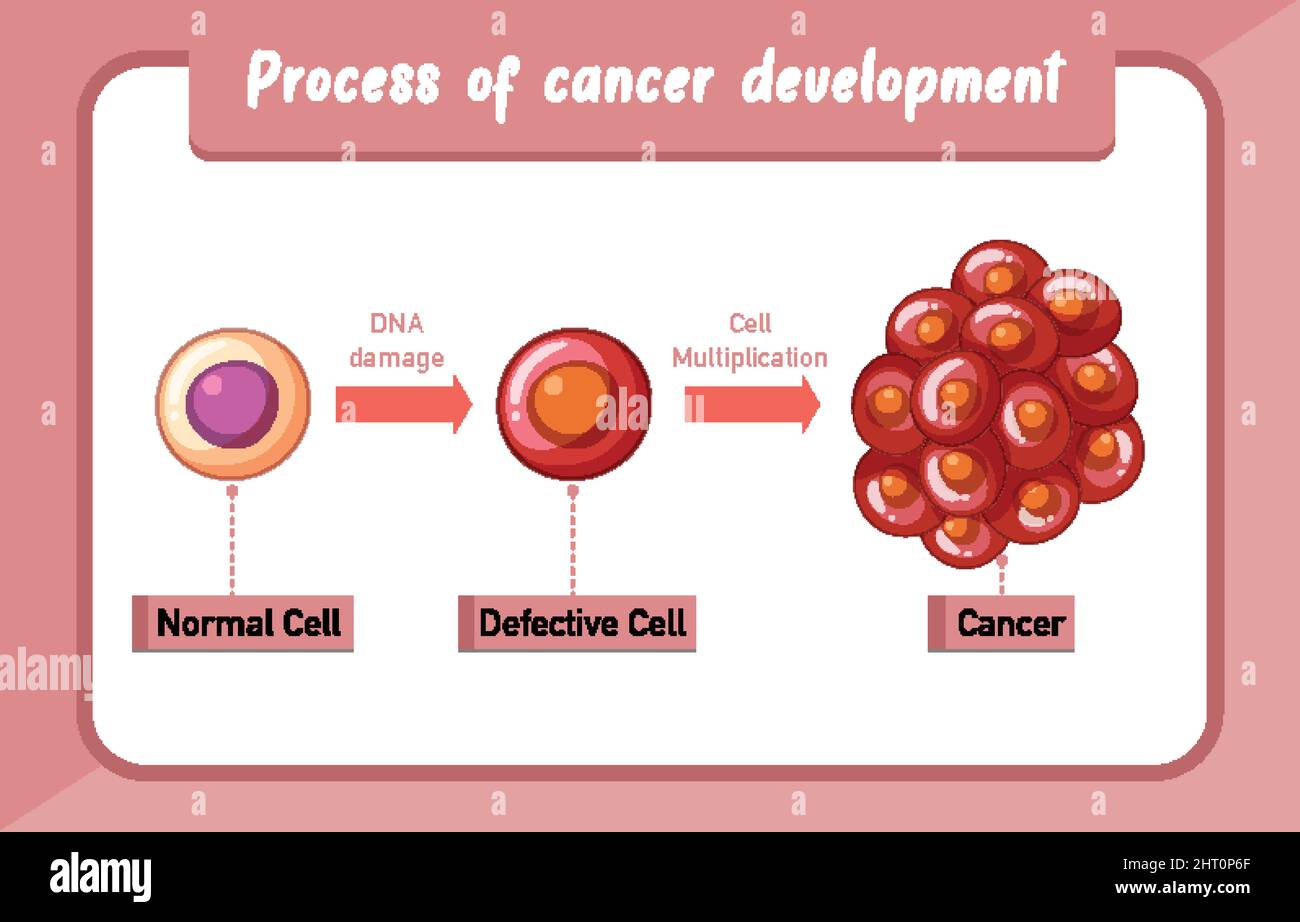 Process of cancer development infographic illustration Stock Vector ...