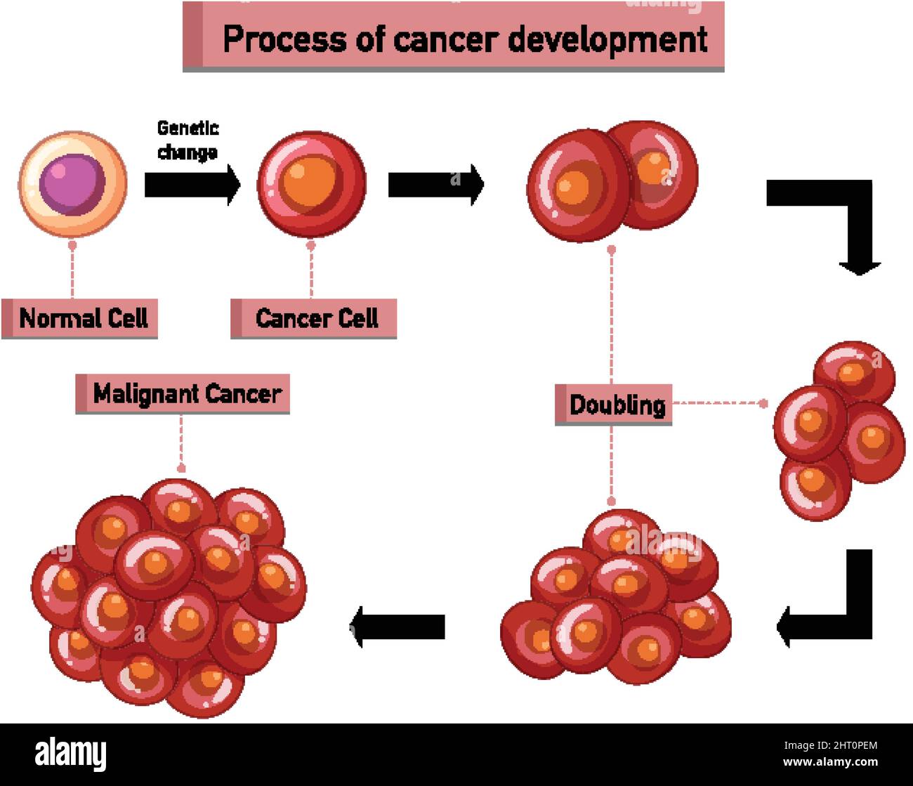 Process of cancer development infographic illustration Stock Vector ...
