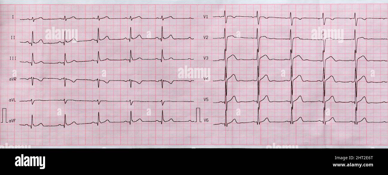 Electrocardiogram graph ekg heart rhythm hi-res stock photography and ...