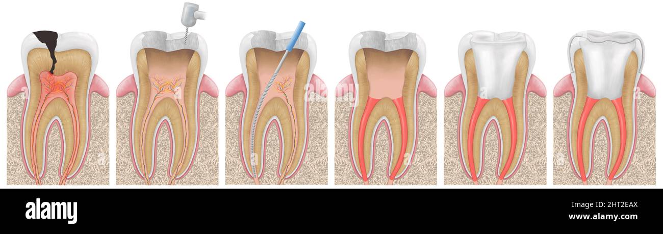Dental illustration.The stages of root canal treatment.Training medical anatomical poster. Stages of treatment of tooth decay. Stock Photo