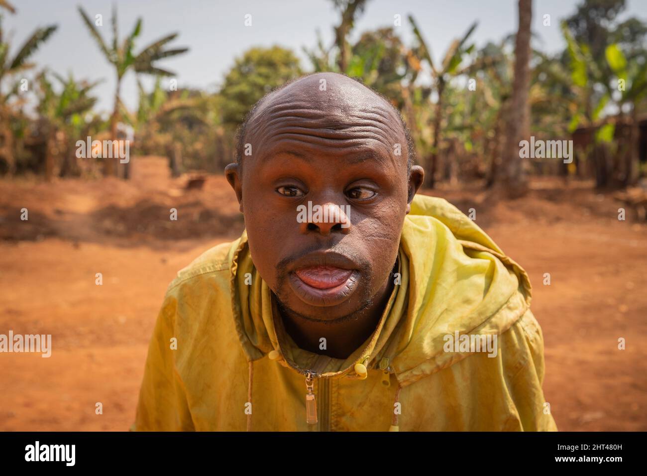 portrait of an adult bald African man with Down syndrome, on a forest background Stock Photo