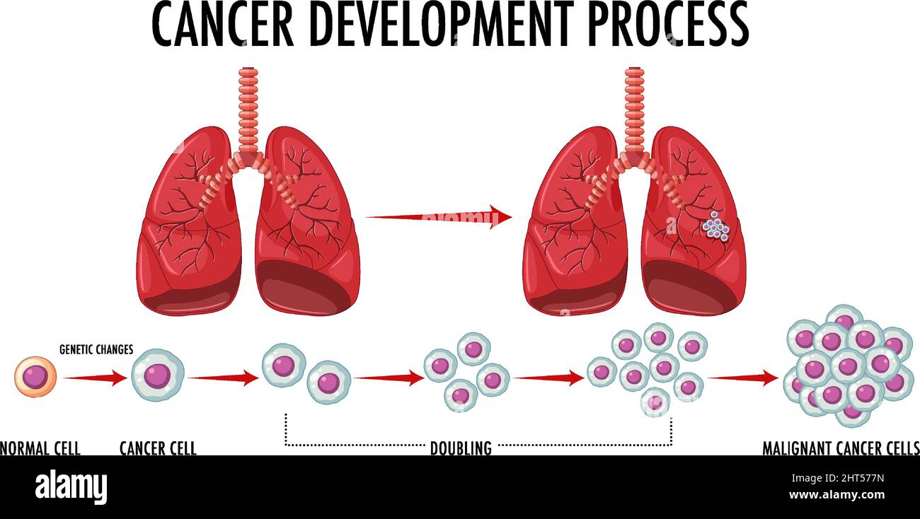 Process of cancer development infographic illustration Stock Vector ...