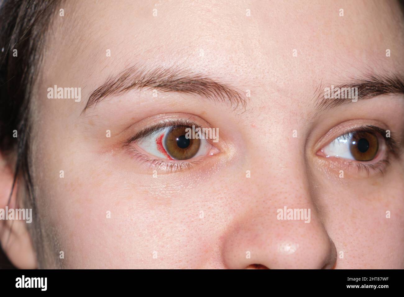 Macro human eyes, burst capillaries, bruising on white of the eye. Red spot after childbirth in a woman in labor, close-up. Stock Photo