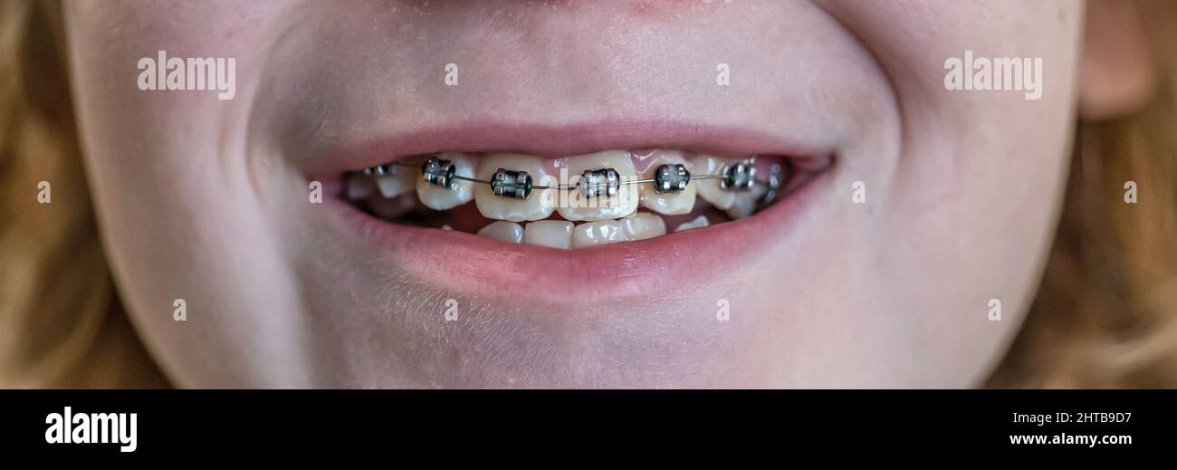 how braces work time lapse