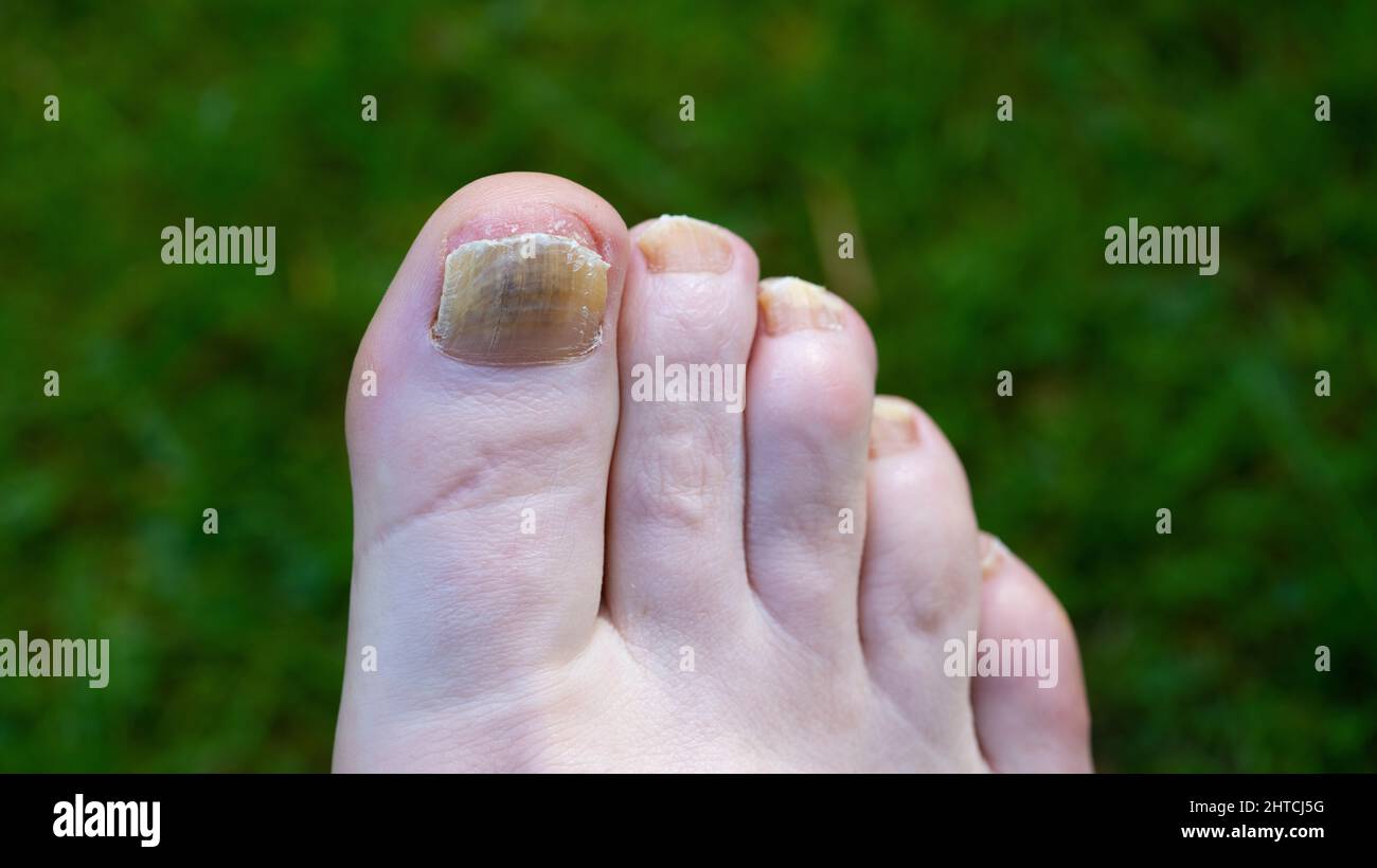 Toenail Fungus showing on the big toe Stock Photo