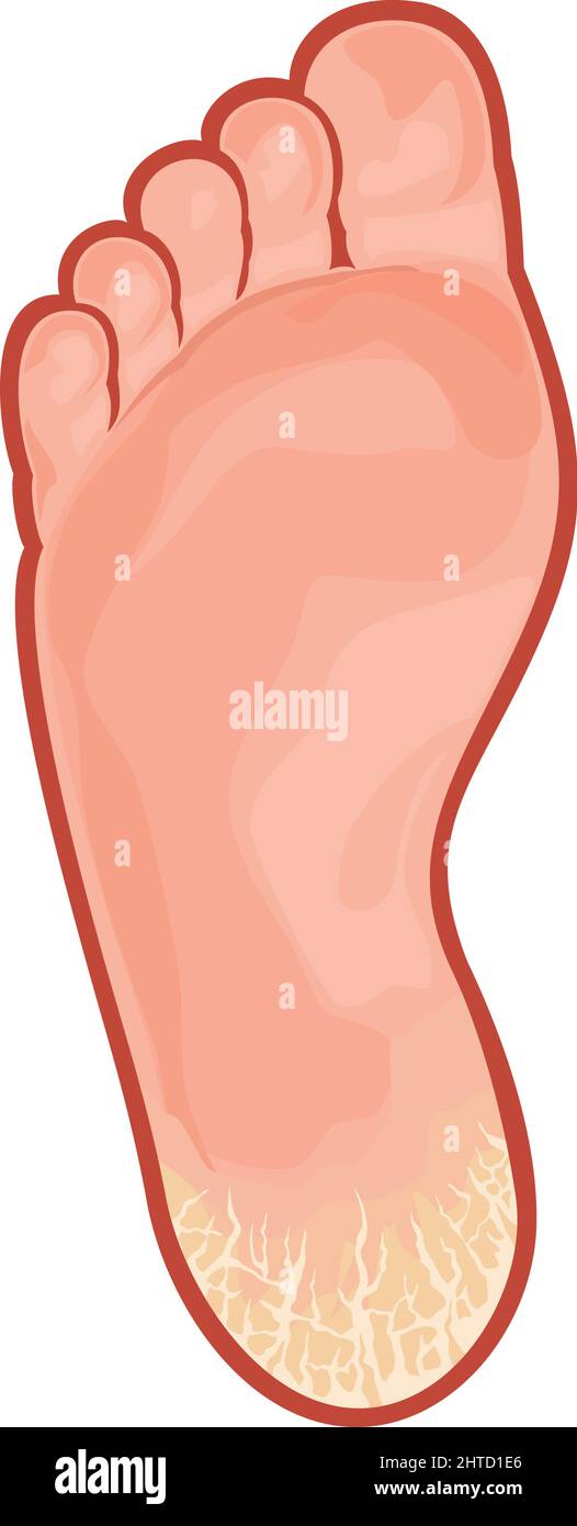 Foot fungus (cracked heel) vector illustration Stock Vector Image & Art