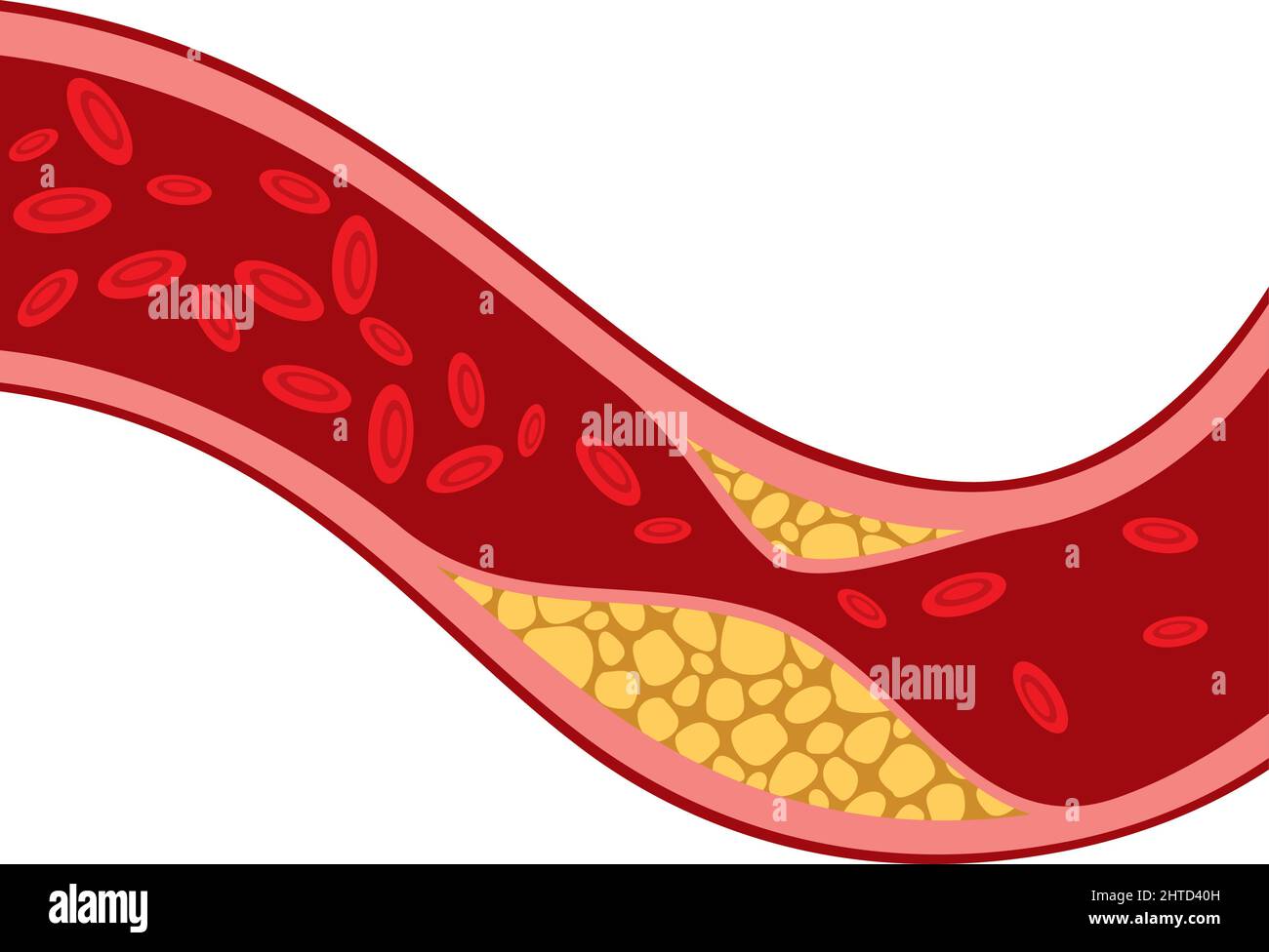 Artery blocked with cholesterol vector illustration Stock Vector Image ...
