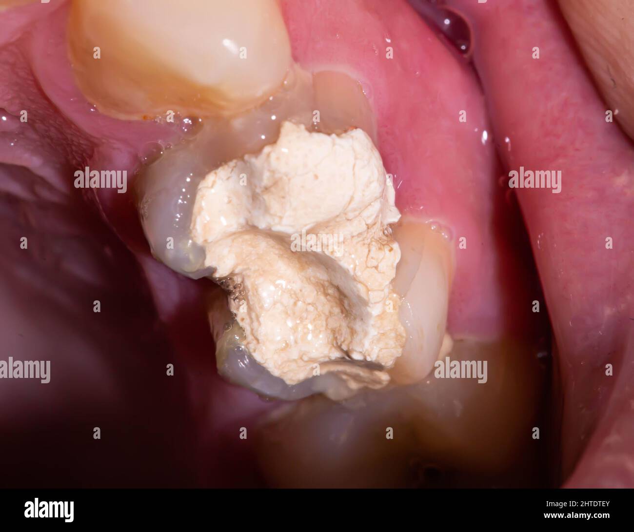 Glass Ionomer Cements Hi res Stock Photography And Images Alamy