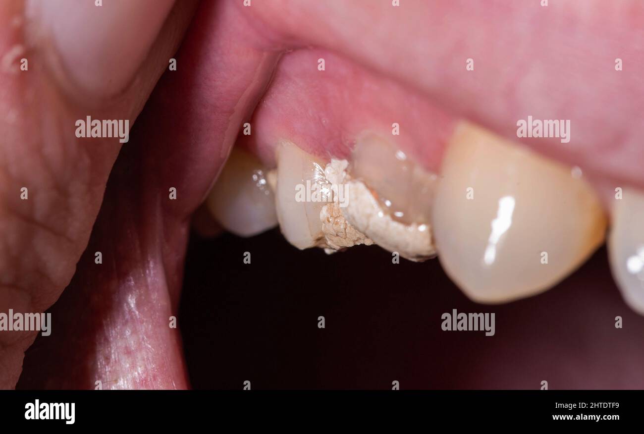 Tooth with temporary filling for nerve destruction and pulpitis treatment.  Stomatology Stock Photo - Alamy