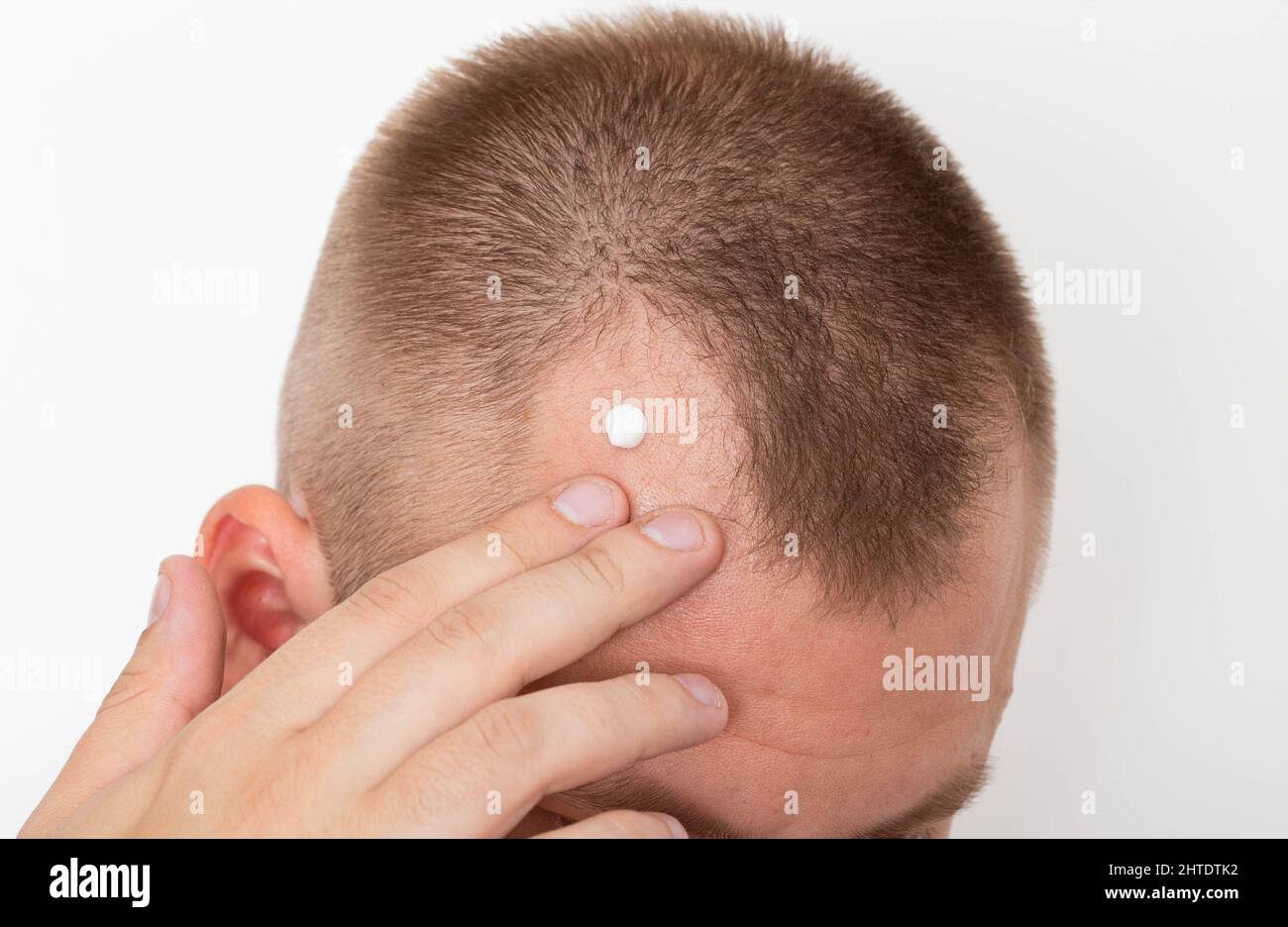 Healing cream for the restoration of damaged hair on a receding hairline on  a man's head. Hair follicle restoration Stock Photo - Alamy