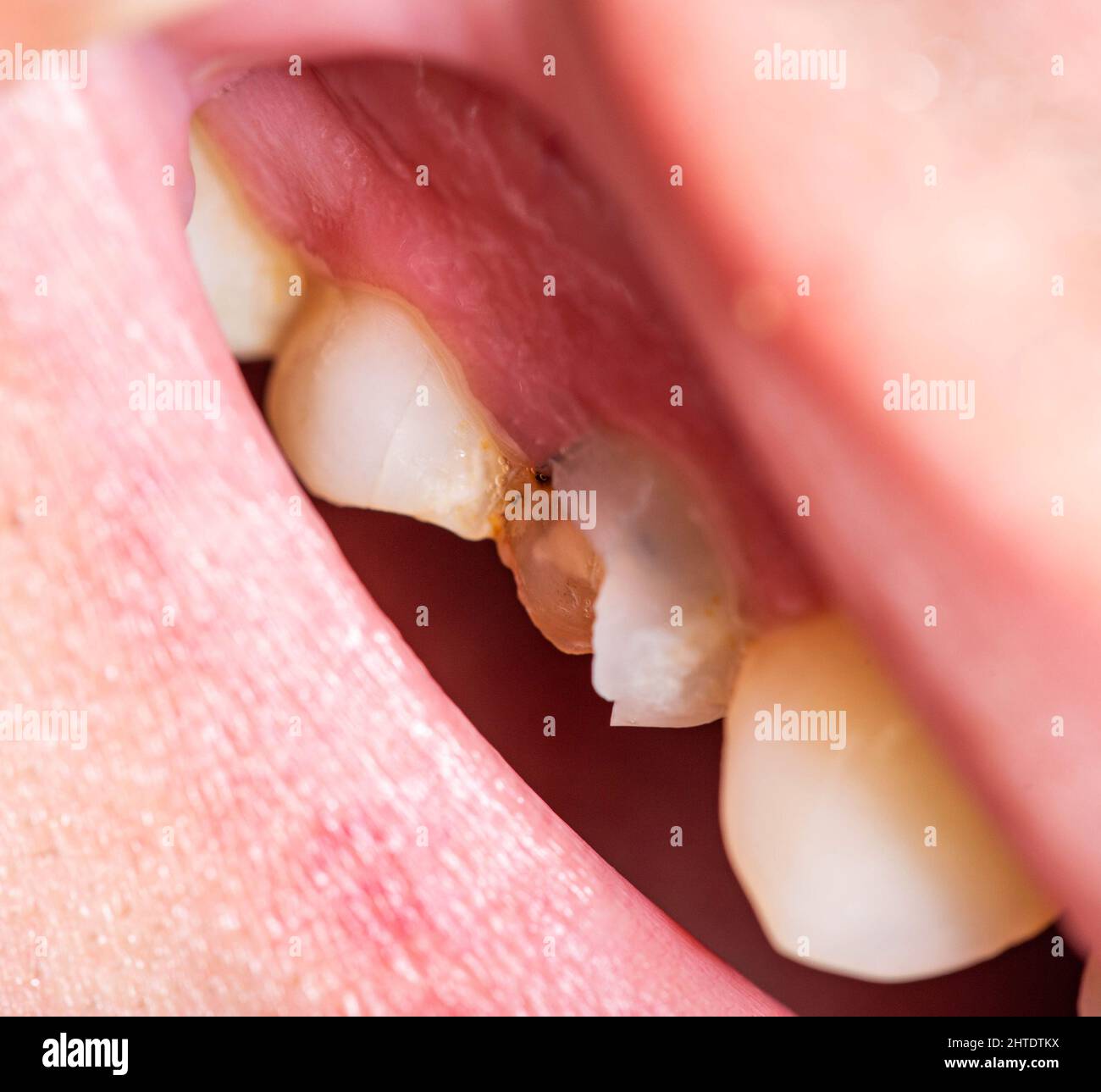 Damaged tooth enamel and chipped tooth piece. Dental restoration with