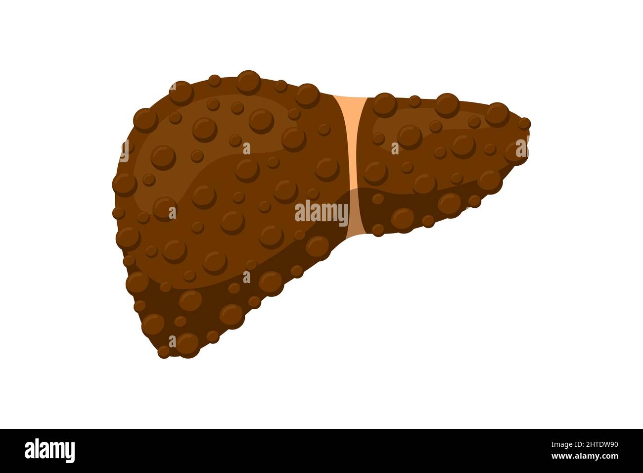 Sick unhealthy liver with cirrhosis or hepatitis. Damaged human exocrine gland internal organ destruction concept. Vector fatty hepatic eps isolated illustration Stock Vector